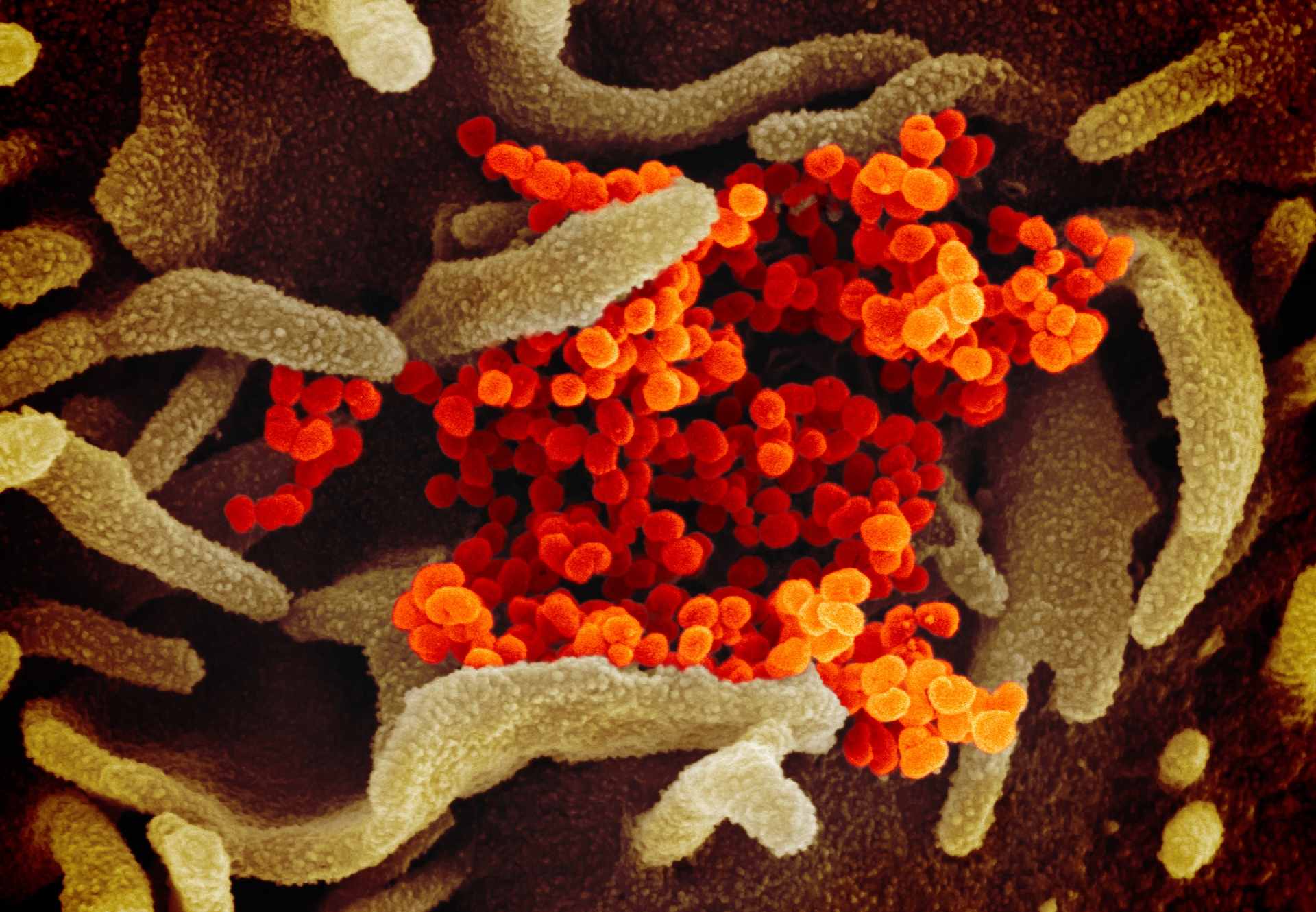 掃描式電子顯微鏡觀察到新型冠狀病毒（橘色顆粒）聚集在病人細胞表面（以淺綠色標示）。  PHOTO:NIAID-RML