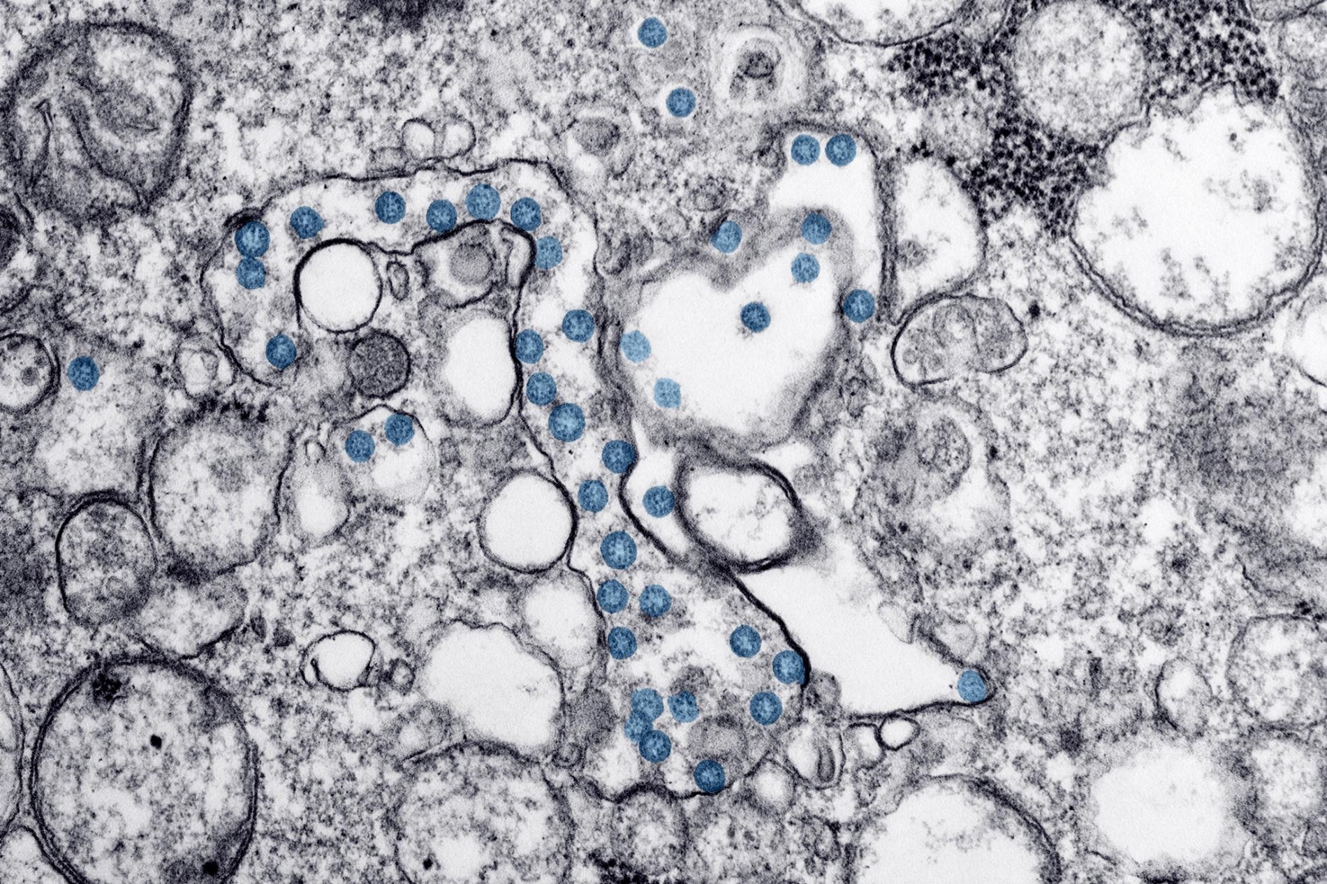 從美國第一位感染COVID-19的病人體內分離出來的新型冠狀病毒，利用穿透式電子顯微鏡觀察到的影像，可看到球形的病毒顆粒（藍色）的病毒基因組（黑色小點）。IMAGE BY CDC / HANNAH A BULLOCK; AZAIBI TAMIN 
