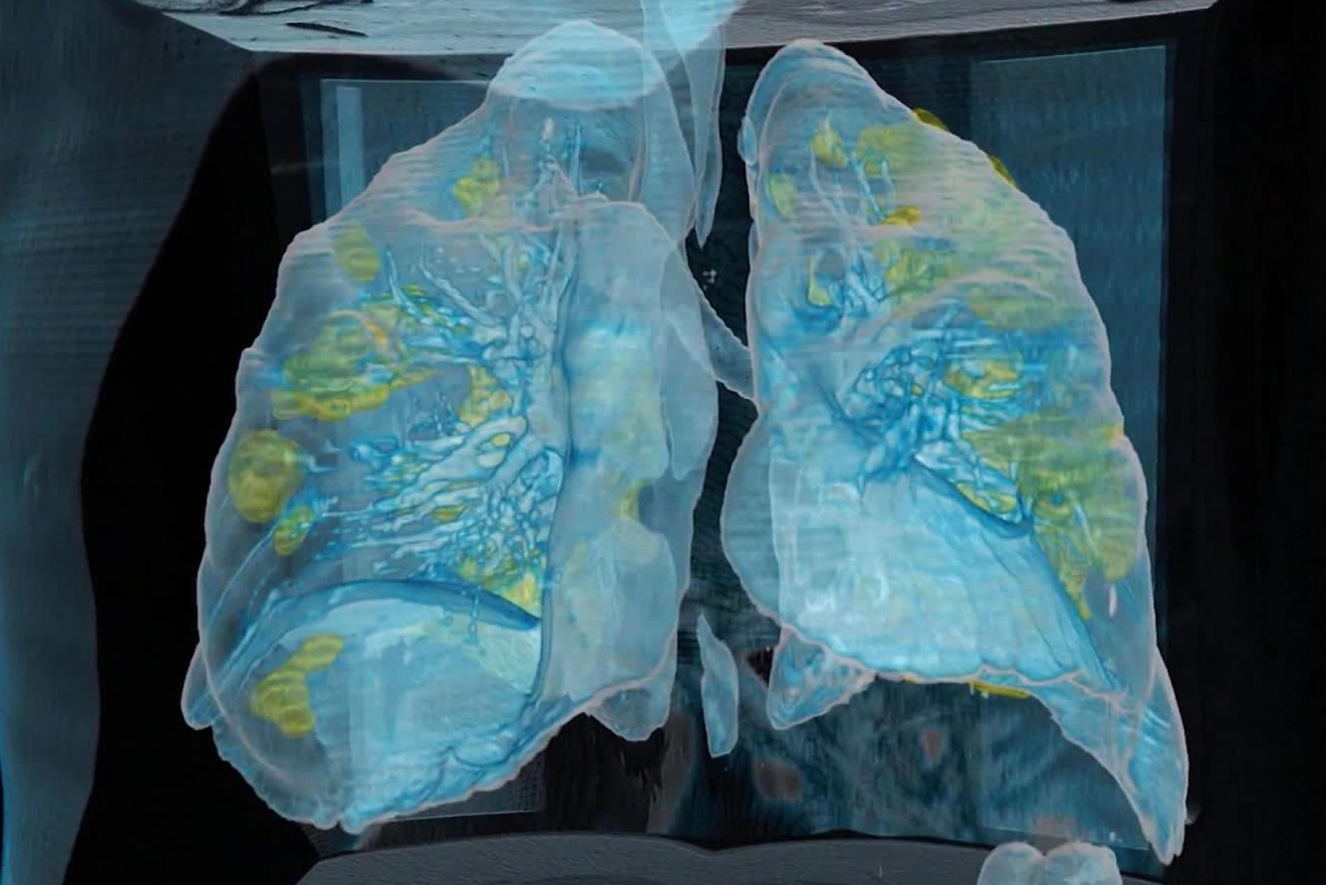 美國喬治華盛頓大學醫院（George Washington University Hospital）有位59歲的男性患者死於COVID-19，從這張以電腦斷層掃描製成的3D模型圖，可以看出患者的肺部有多處損傷（黃色區域）。PHOTOGRAPH COURTESY GEORGE WASHINGTON HOSPITAL AND SURGICAL THEATER