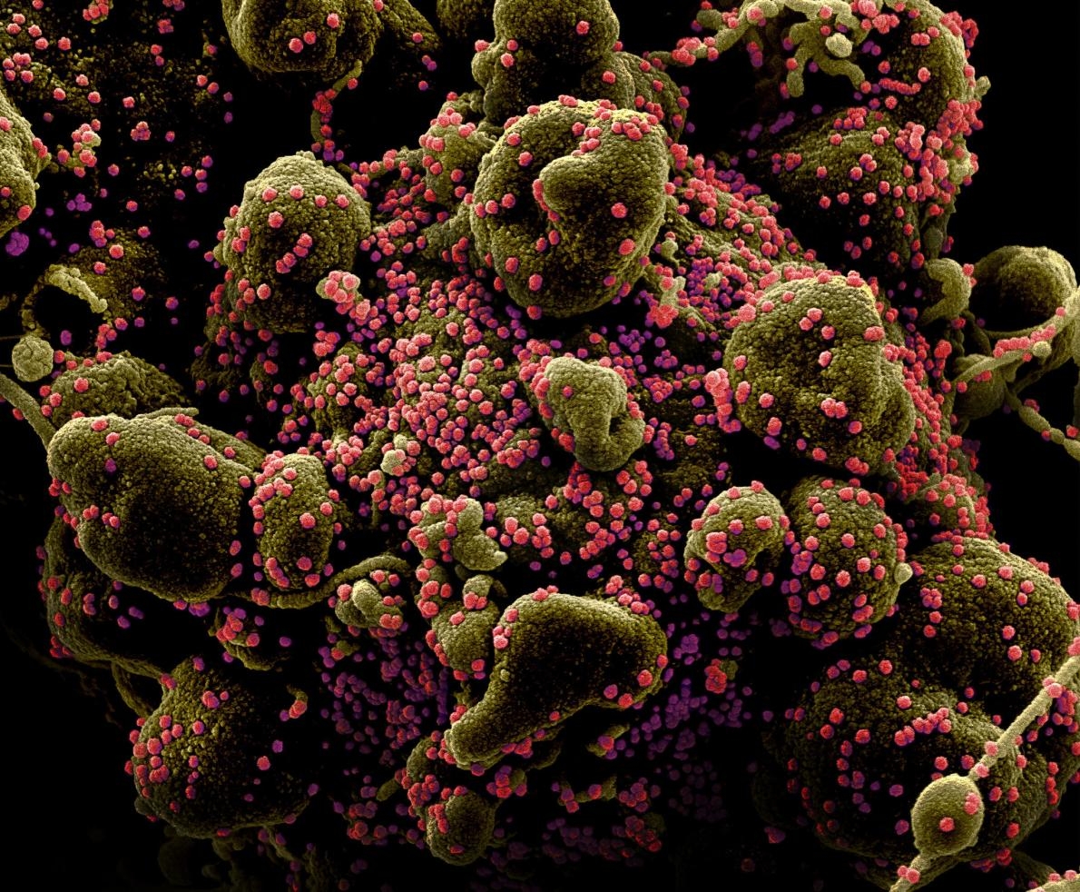 一顆人類細胞（綠褐色）嚴重受到從人類患者身上分離的SARS-CoV-2病毒顆粒（粉紅色）感染。這張影像是在馬里蘭州迪特里克堡的美國國家過敏與傳染病研究所綜合研究機構（NIAID Integrated Research Facility）拍攝與強化色彩。疫苗會預防病毒複製及佔領宿主細胞。COLORIZED SCANNING ELECTRON MICROGRAPH BY NATIONAL INSTITUTE OF ALLERGY AND INFECTIOUS DISEASES, NIH