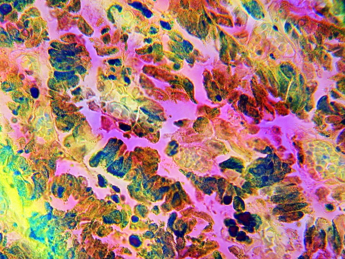 惡性黑色素瘤（粉紅色部分）是最令人恐懼的人類癌症之一。擴散速度快、能從原始病灶擴散到幾乎所有器官，包括如本照片所示的肺部。這些影像中的色彩並非細胞真正的天然顏色。IMAGE BY DR. CECIL H. FOX, SCIENCE SOURCE