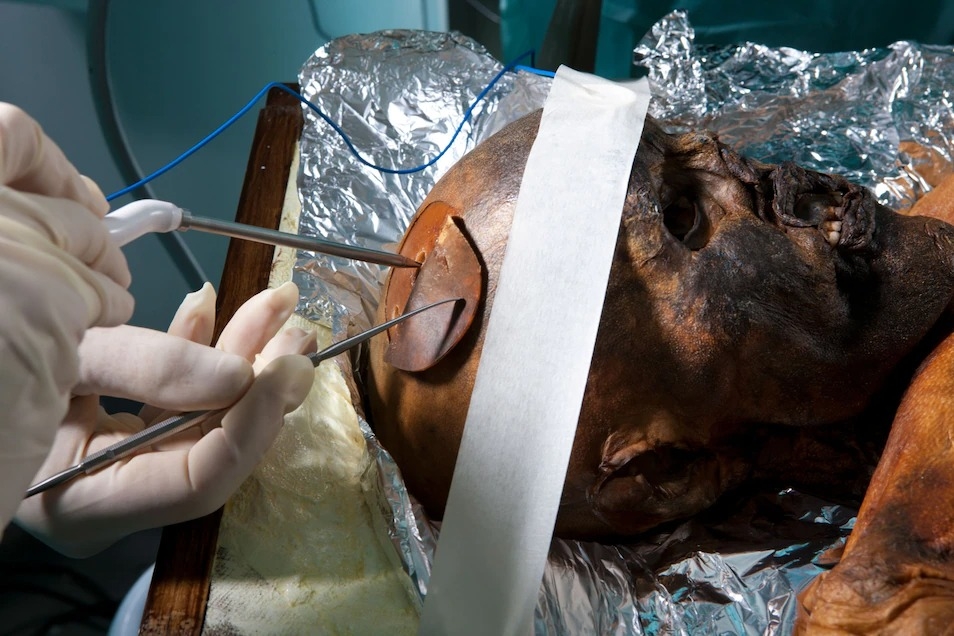 神經外科醫生從奧茨的腦部取樣本。藉由研究他的遺體，科學家能更加了解新石器歐洲的人們如何生活並死去──並且為當代人類健康提出洞見。PHOTOGRAPH BY ROBERT CLARK, NAT GEO IMAGE COLLECTION 