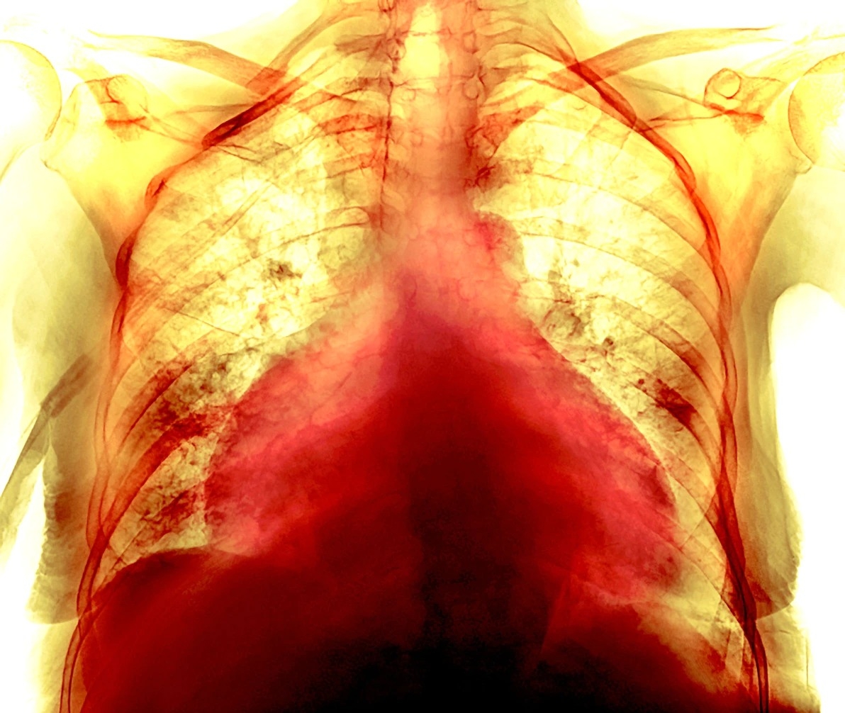 這張彩色胸腔X光影像顯示一名74歲女性COVID-19病患的肥大心臟。有些病患從COVID-19康復的幾個月後持續出現心血管症狀──即使他們的胸腔掃描及其他檢查結果都正常也一樣。PHOTOGRAPH BY P. MARAZZI/SCIENCE SOURCE