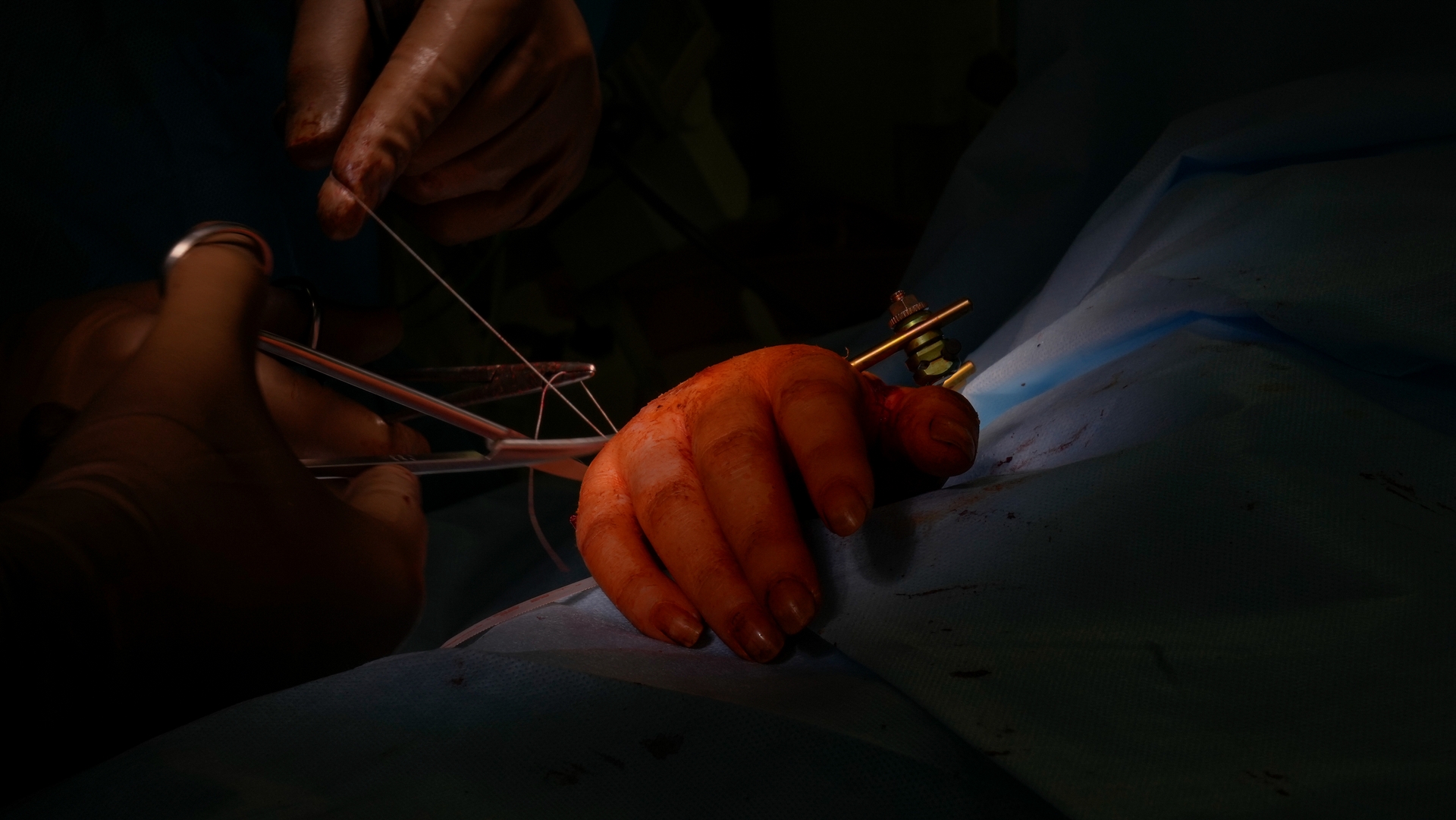 基輔奧瑪迪特醫院（Okhmatdyt）的醫生正為一位女性動手術，移除俄羅斯迫擊砲攻擊留下的炸彈碎片。（Sony α1拍攝）