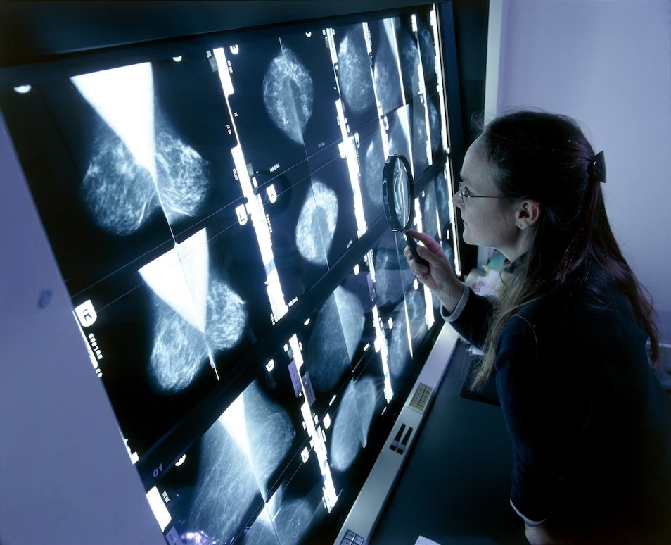  一位放射科醫師正在研究燈箱上放的乳房攝影照片，這是英國一項全國乳房攝影資料庫的一部分。這項計畫將掃描標準化，這樣更容易相互比較，並能更迅速地診斷出乳房攝影可能顯示的異常之處。 PHOTOGRAPH BY JAMES KING-HOLMES/SCIENCE SOURCE 