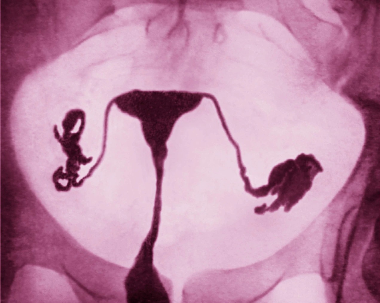 這張色彩增強子宮輸卵管攝影顯示女性生殖系統，包含輸卵管和健康的子宮。PHOTOGRAPH BY JAMES CAVALLINI, SCIENCE SOURCE