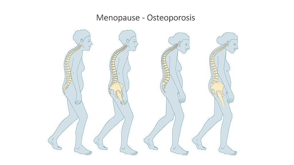 女性是骨質疏鬆高危險群，新研究發現空汙會讓骨質更快流失。圖片來源：SMART-Servier Medical Art （CC BY-SA 3.0）