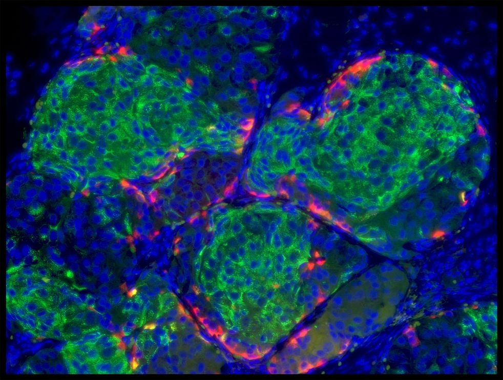 幹細胞新療法有一天可能治癒第一型糖尿病