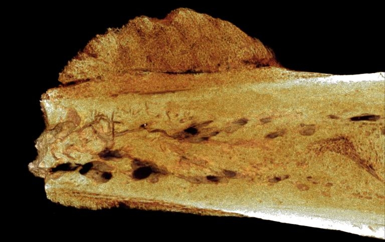 最早人類癌症現蹤：170萬年的老骨頭