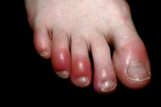 神祕的「COVID腳趾」仍使科學家困惑不解