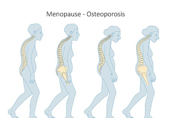 研究：空汙加劇停經婦女骨質疏鬆 腰椎骨質流失加倍