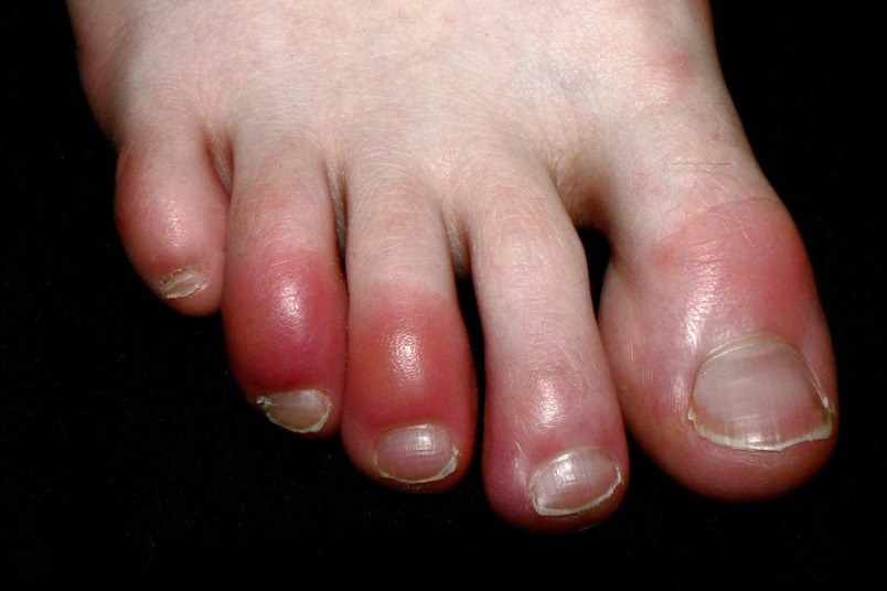 神祕的「COVID腳趾」仍使科學家困惑不解